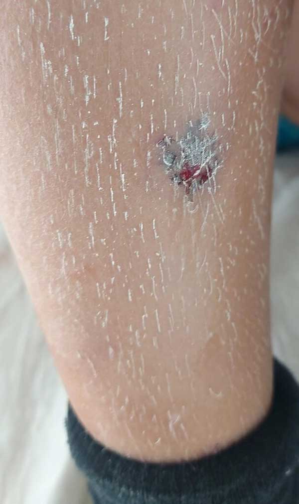 Καστοριά: Αδέσποτο τσομπανόσκυλο δάγκωσε δύο 8χρονα παιδιά